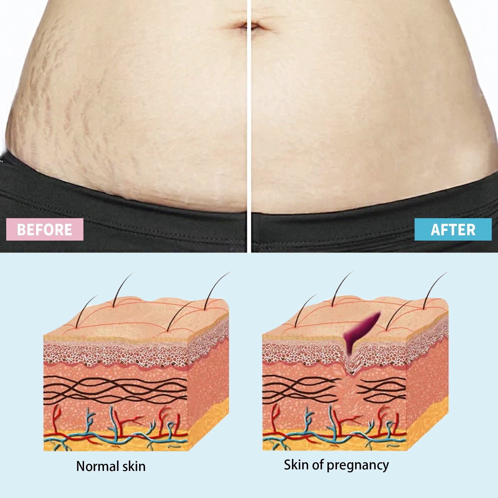 Wiieey Pregnancy Scar Care Cream, Moisturizes, Repairs Skin, Reduces Pregnancy Scars, and Smoothes Skin