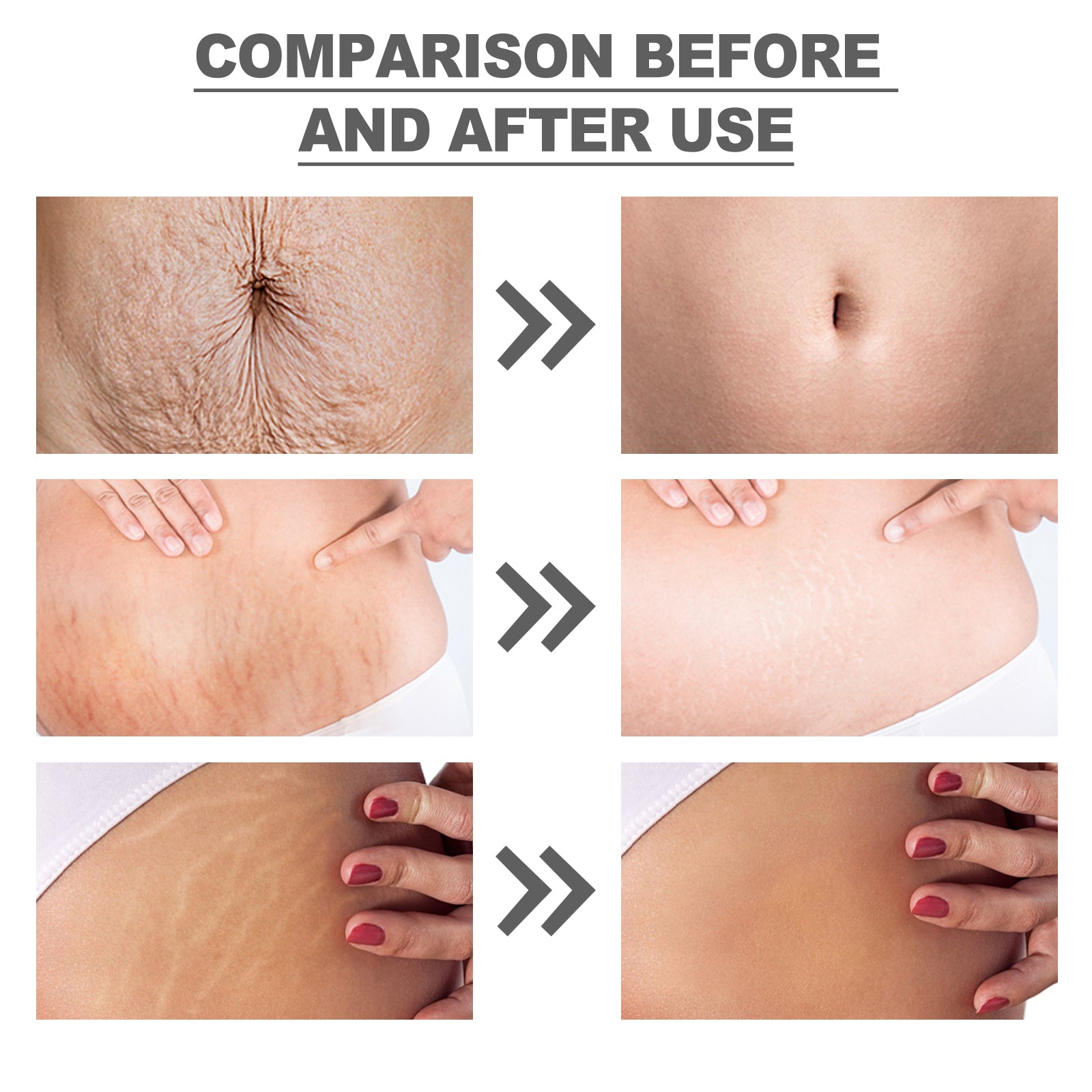 Wiieey Snail Essence Pregnancy Cream, Tightens Skin, Repairs, and Reduces Stretch Marks and Postpartum Stretch Marks