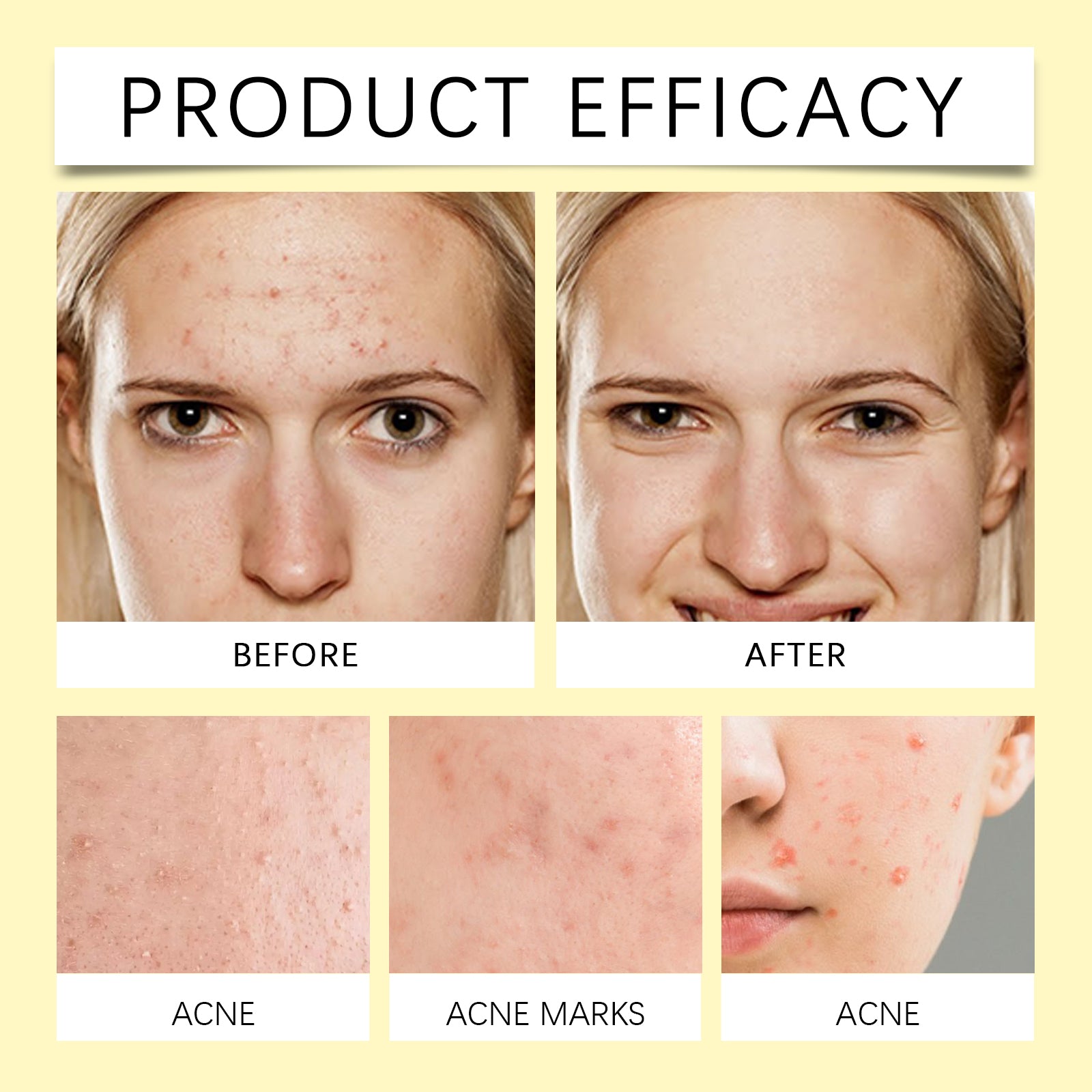 Wiieey Star Acne Patch, Helps Reduce Acne and Acne Scars, Cleanses Closed Comedones, and Portable Cartoon Design