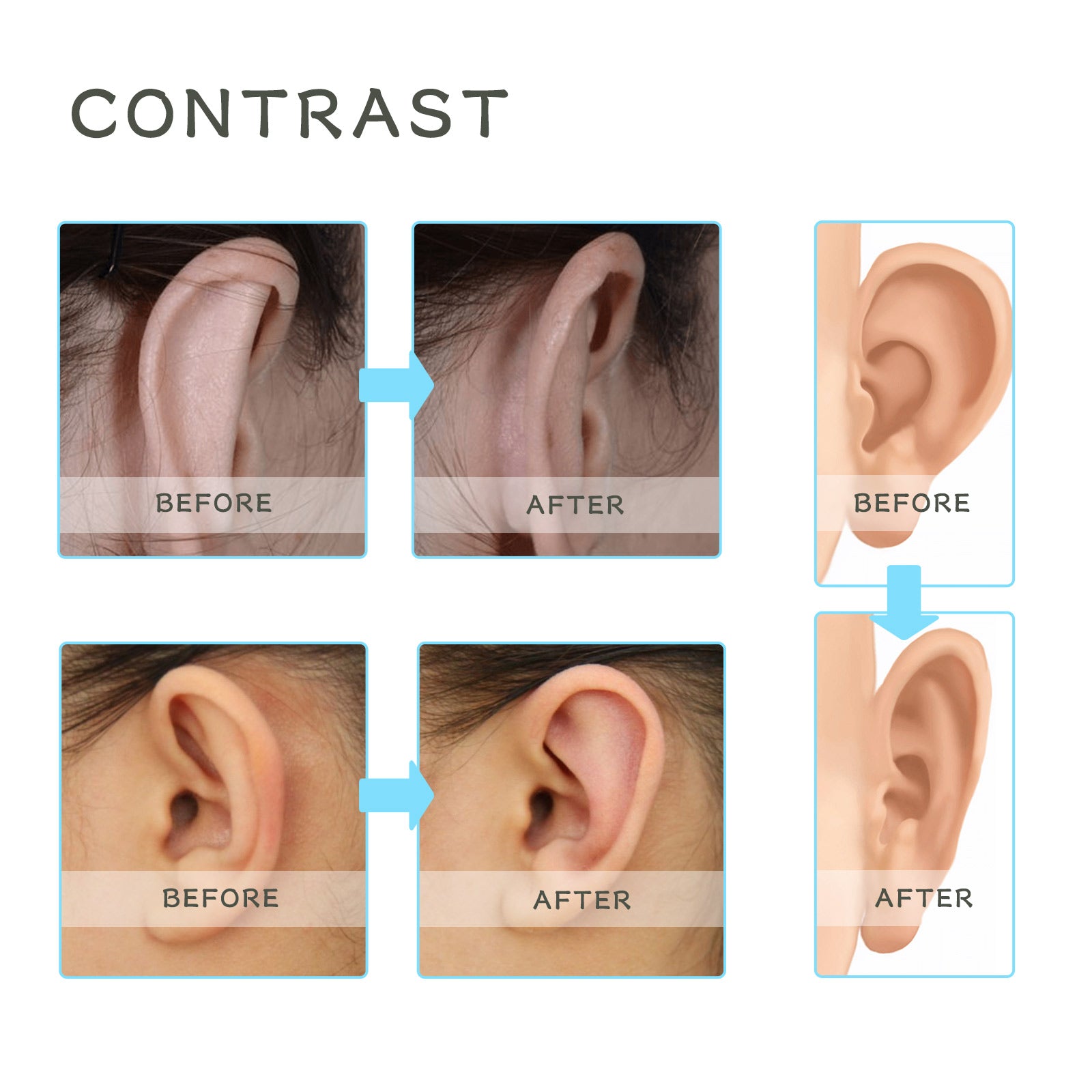 Wiieey Silicone Ear Correction Patch, Helps Correct Children's Prominent Ears, Gentle, Waterproof, and Breathable
